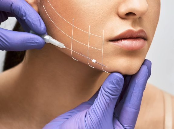 Facial lifting thread. Thread facelift with arrows on face for woman's skin, procedure facial contouring using mesothreads